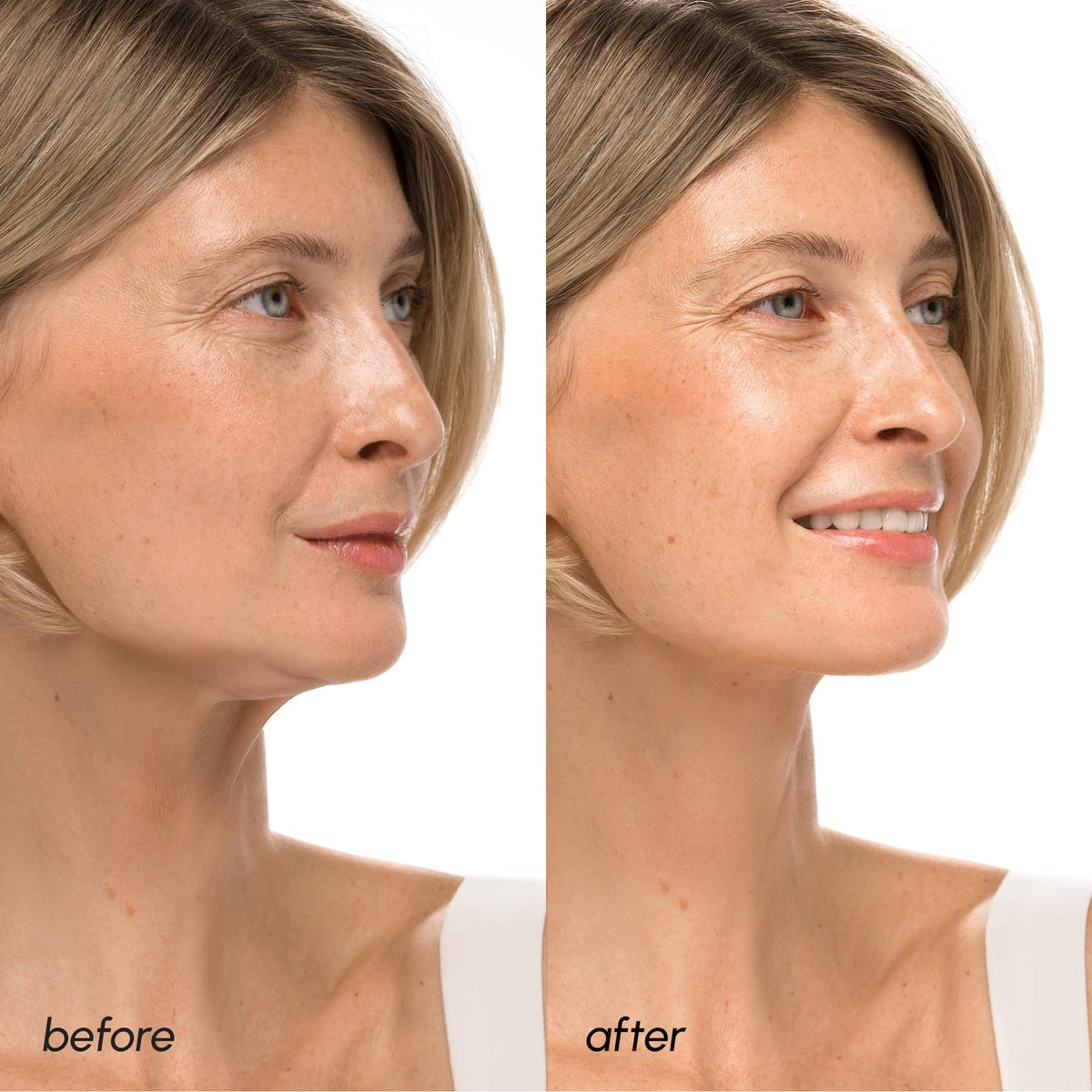 MAREE mask applied on model front showcasing jawline lift