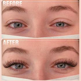Mavphnee application demo of clusters on eyelid showing subtle enhancement
