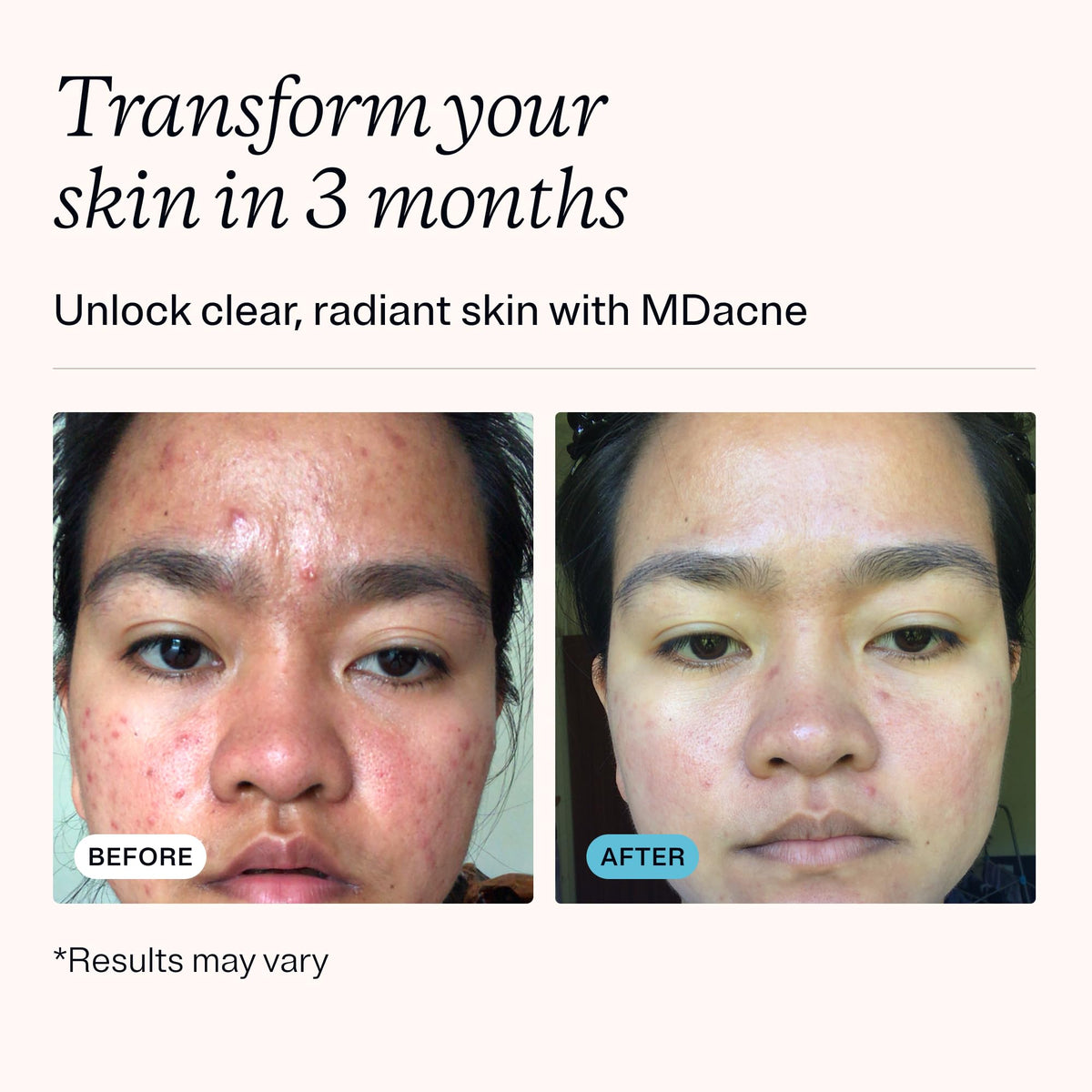 MDacne salicylic acid cleanser pump bottle highlighting pore-clearing benefit