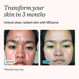 MDacne salicylic acid cleanser pump bottle highlighting pore-clearing benefit