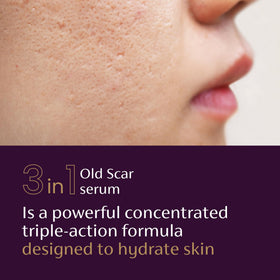 Hand applying Mederma scar serum to skin demonstrating targeted hydration and smoothing