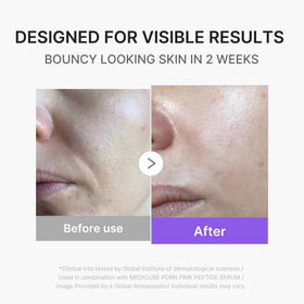 medicube device emitting blue light on skin helping refine pores and texture benefit