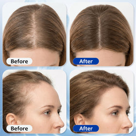 MGVAASURC roll-on being applied to scalp for targeted treatment