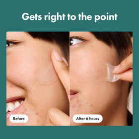 Mighty Patch ingredients label highlighting salicylic acid and niacinamide