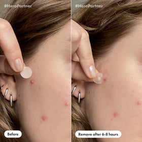 Mighty Patch Invisible applied on face during day offering subtle coverage benefit