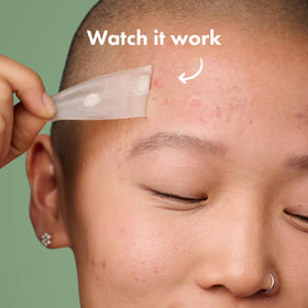 Mighty Patch applied to jawline illustrating secure fit and protection during movement