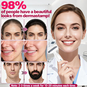 MONESAO derma stamp held in hand to show scale and ergonomic grip benefit