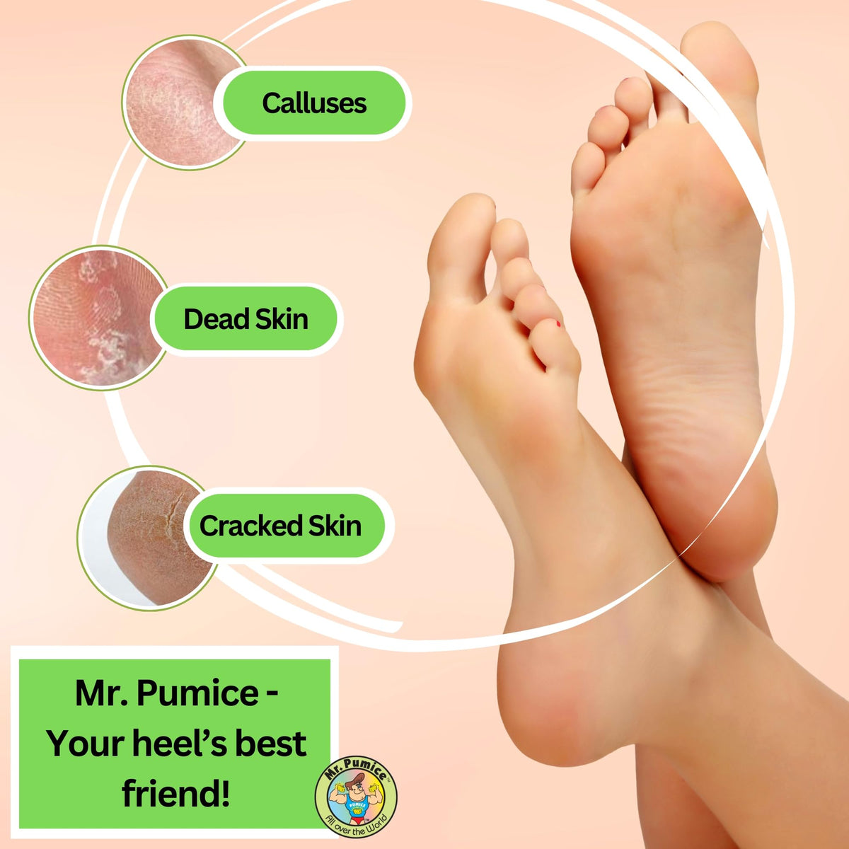 Mr. Pumice used on heel during foot soak for callus reduction