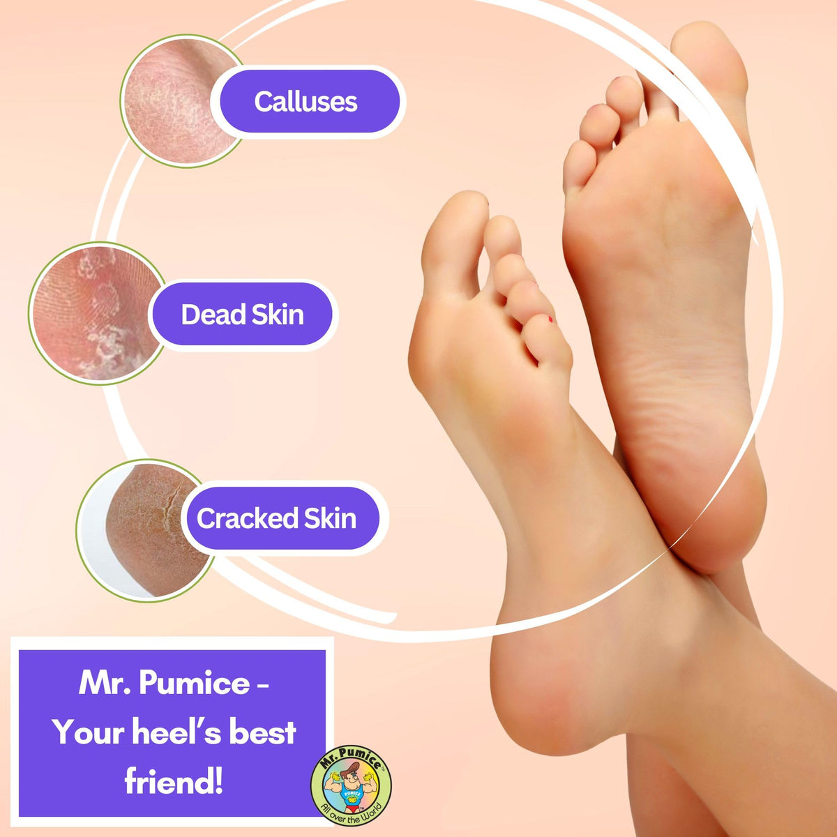 Mr. Pumice being used on heel to reduce callus thickness and restore smoothness