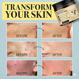 MTGBO before-and-after elbow area demonstrating reduced dryness and smoother skin