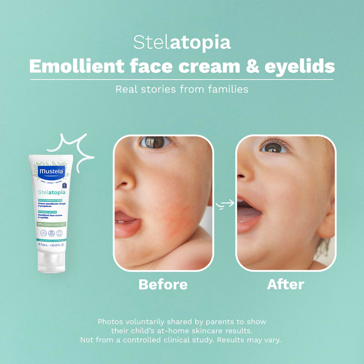 Mustela applied on baby cheek illustrating soothing hydration and reduced redness