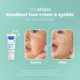 Mustela applied on baby cheek illustrating soothing hydration and reduced redness