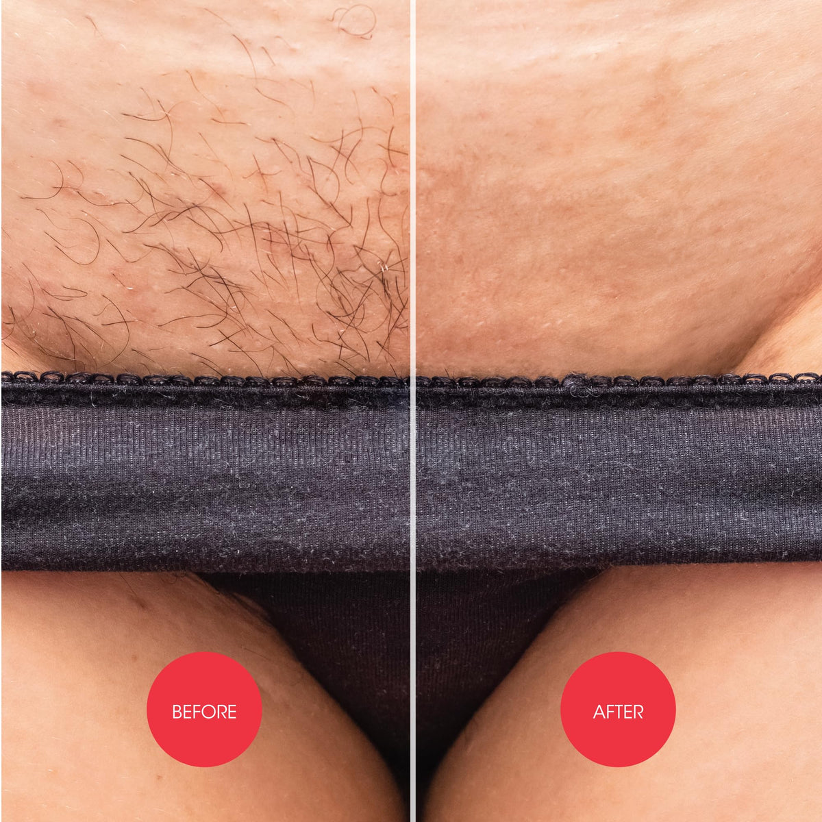 Application of Nad's on bikini line demonstrating even coverage and easy use