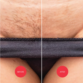 Application of Nad's on bikini line demonstrating even coverage and easy use