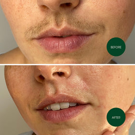 Nad's strip with gentle moisturizer for soothing aftercare and calm skin