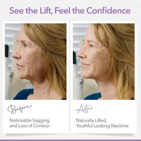 NECK LESS before and after profile showing defined jawline benefit