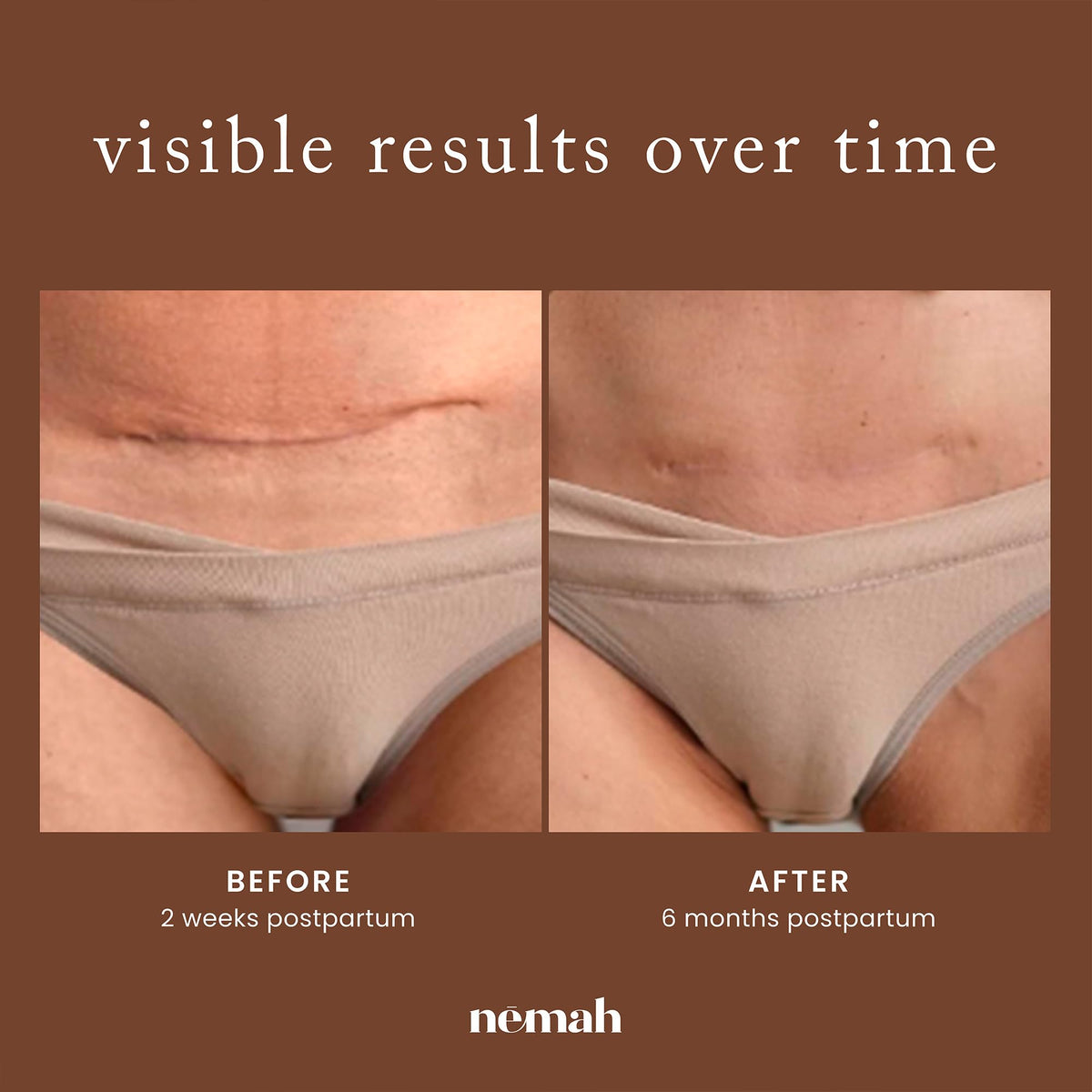 Nemah inside postpartum bag portraying convenient daily scar care