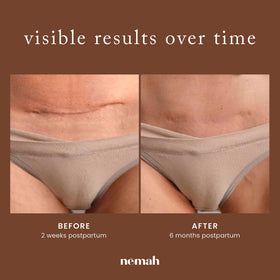 Nemah inside postpartum bag portraying convenient daily scar care