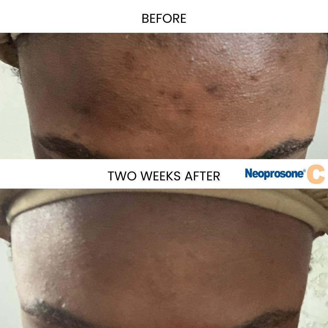 Neoprosone pump dispensing serum demonstrating easy, mess-free application