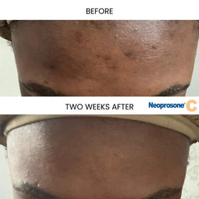Neoprosone pump dispensing serum demonstrating easy, mess-free application