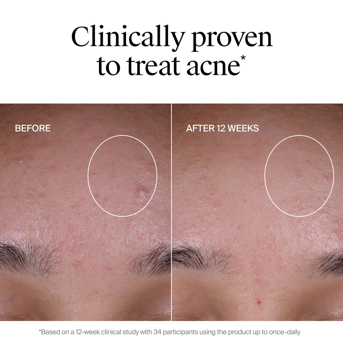 Neutrogena ingredient highlights graphic showing multi-acid blend