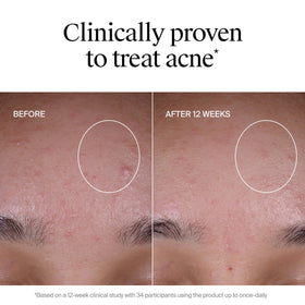 Neutrogena ingredient highlights graphic showing multi-acid blend