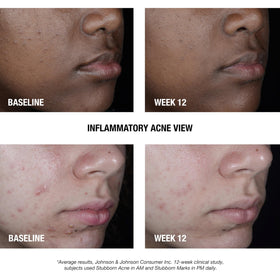 Neutrogena ingredient label detail highlighting 2.5% benzoyl peroxide benefit