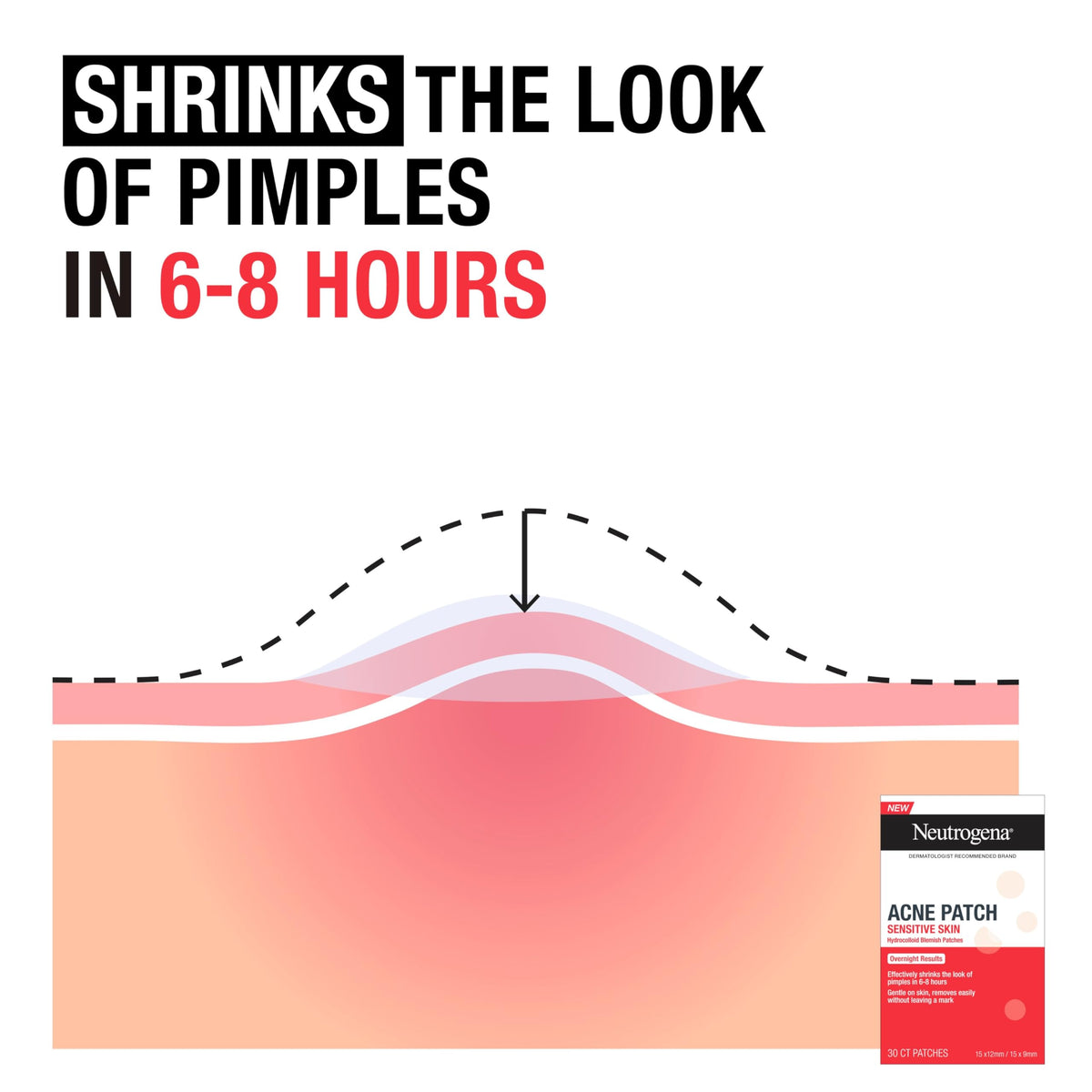 Neutrogena comparison of 9mm and 12mm patches for targeted coverage