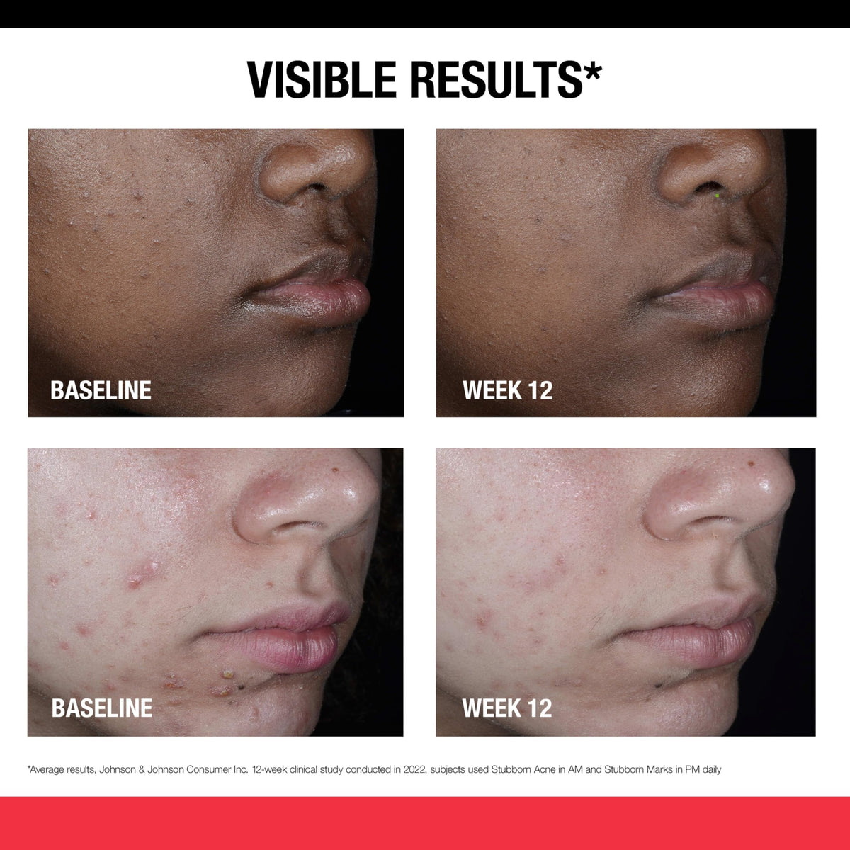 Neutrogena before and after composite showing reduced post-acne marks benefit