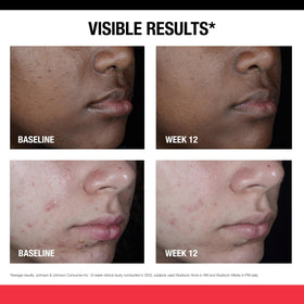 Neutrogena before and after composite showing reduced post-acne marks benefit