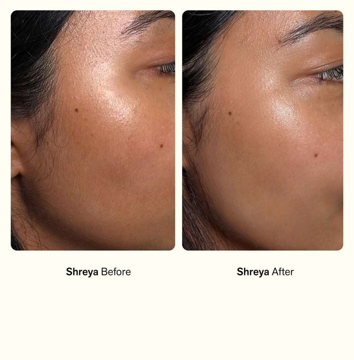Close-up of skin texture after treatment showing Nimbi smoothing effect