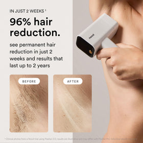 Nood Flasher Pro handle detail showing ergonomic grip and comfort during treatments