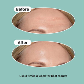 NURIVE patch held in hand to show large size and coverage for forehead lines