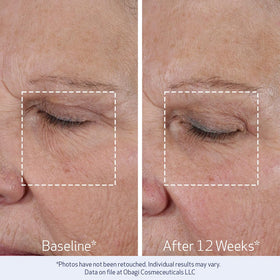 Obagi Medical application on cheek demonstrating lifting motion and visible smoothing