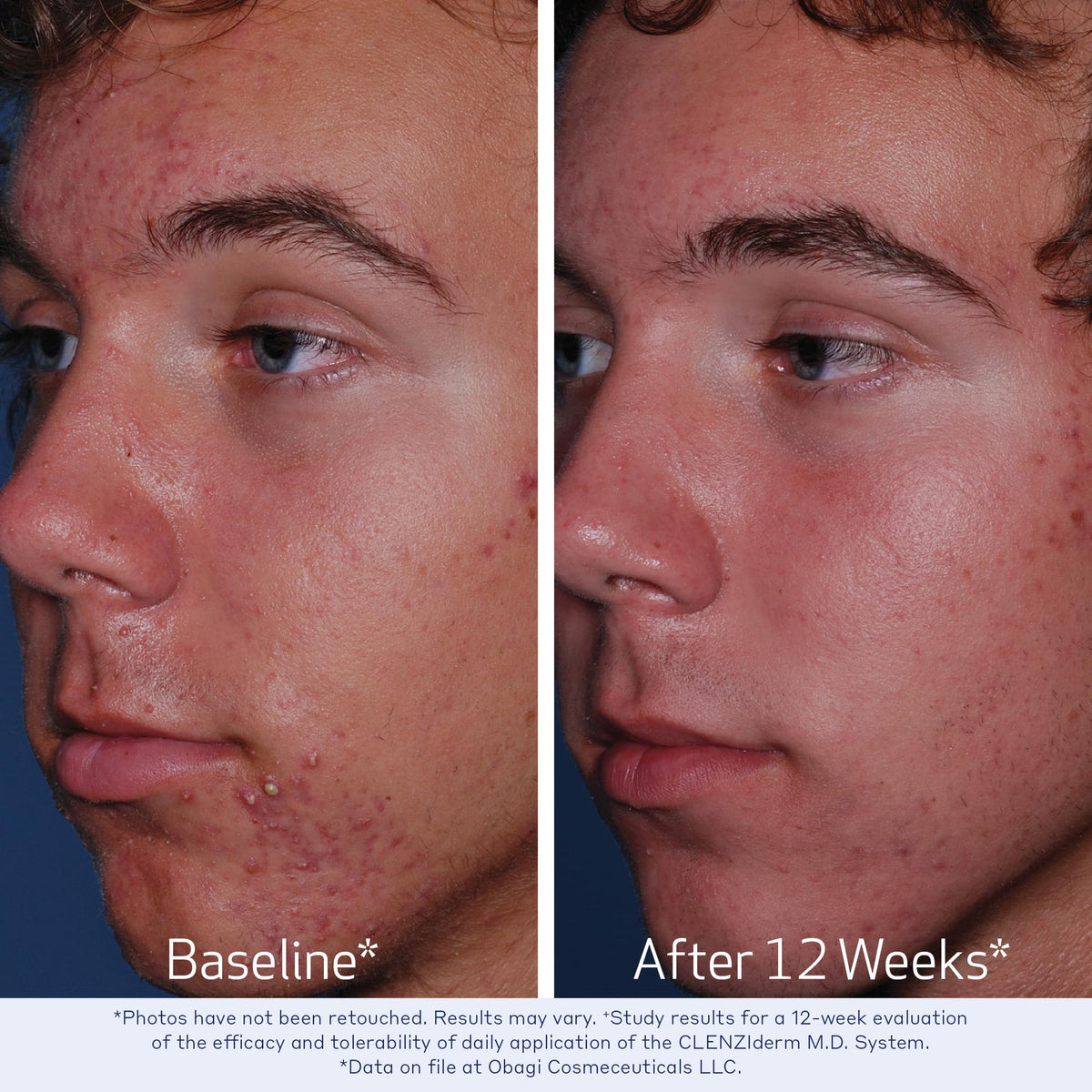 Obagi Medical applied to cotton pad showing easy application and exfoliation