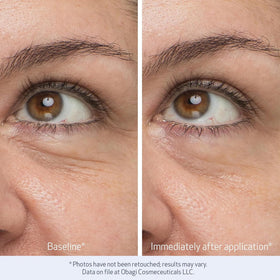 Obagi Medical before and after example of under-eye brightening