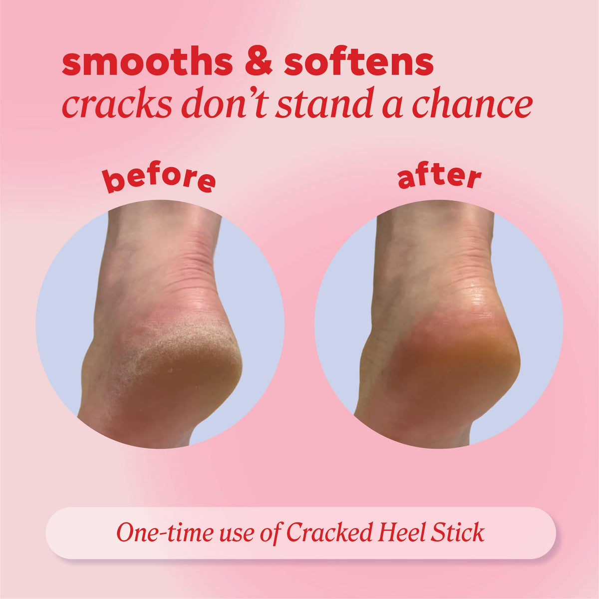 Onyx Professional balm applied to heel demonstrating targeted relief