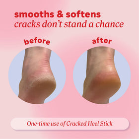 Onyx Professional balm applied to heel demonstrating targeted relief