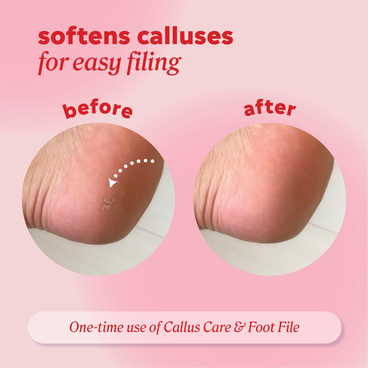 Onyx Professional being applied to heel to soften callus before filing