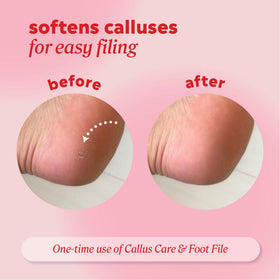 Onyx Professional being applied to heel to soften callus before filing