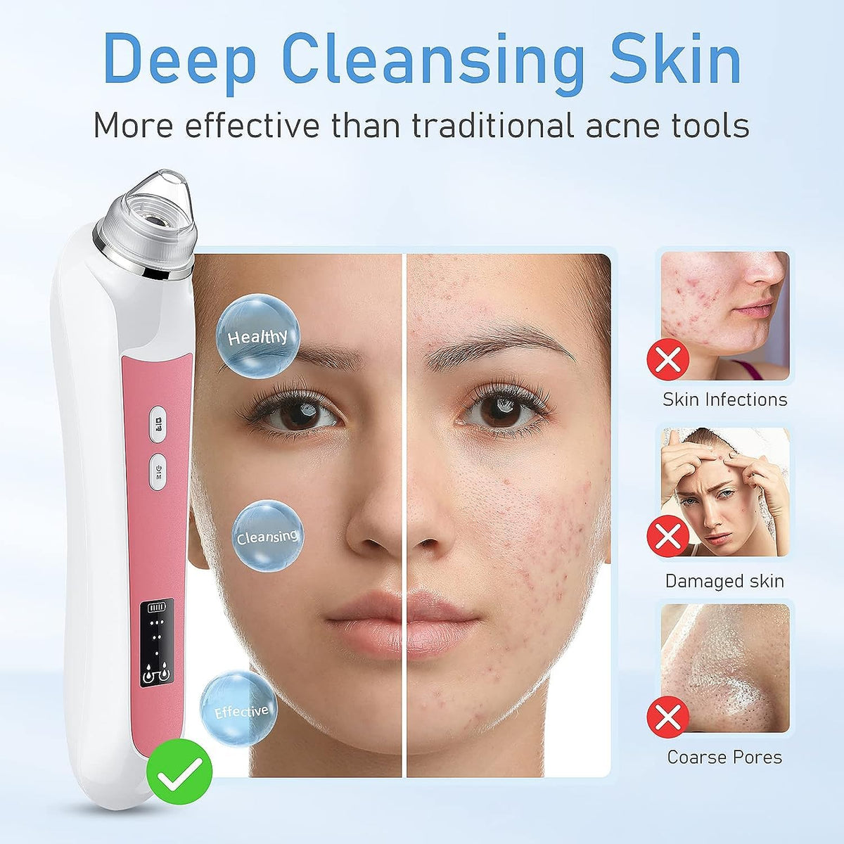 Ottleba device in use on nose demonstrating targeted blackhead removal benefit