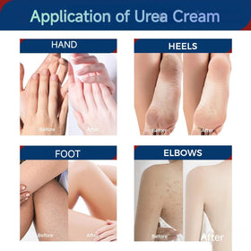 OUKEYA label close-up displaying key actives like 42% urea and 2% salicylic acid