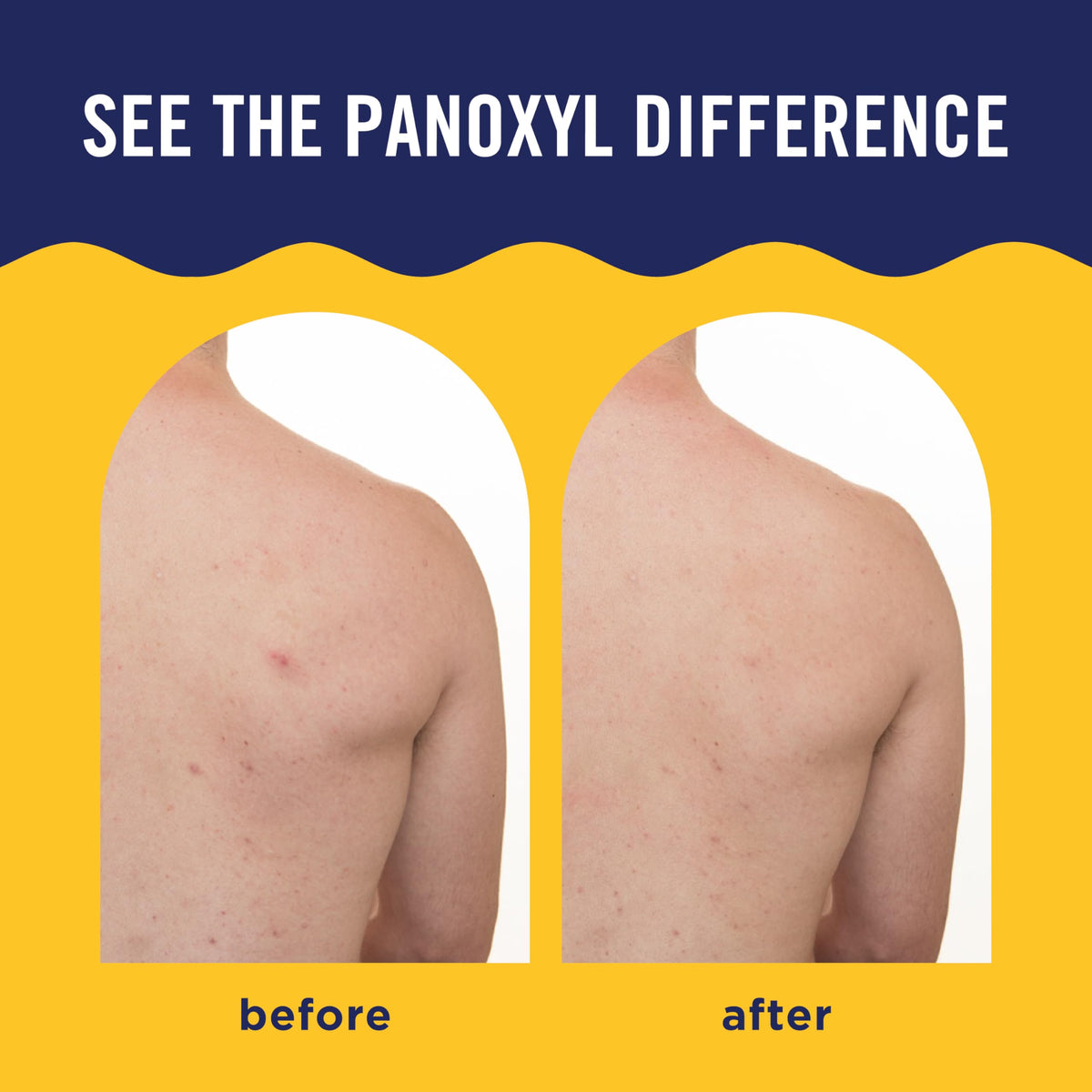 PanOxyl label close-up highlighting active ingredients and treatment benefit