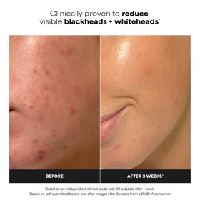 Paula's Choice close-up of pad solution texture highlighting even salicylic delivery