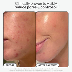 Person using Paula's Choice pad on face illustrating quick application benefit
