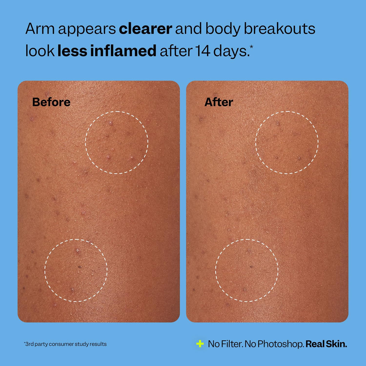 Peach Slices open package revealing six flexible hydrocolloid patches