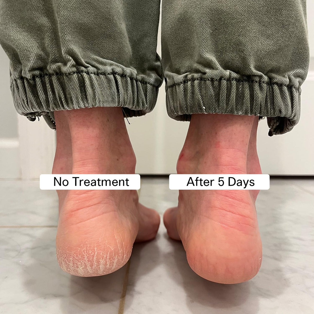 Pedestrian Project applying balm to heel demonstrating targeted crack repair