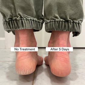 Pedestrian Project applying balm to heel demonstrating targeted crack repair