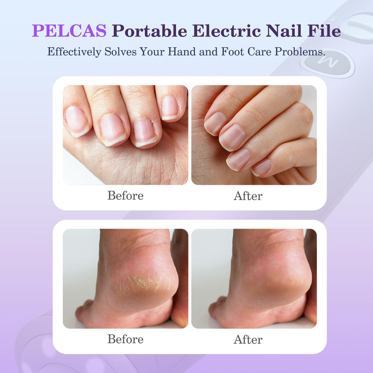PELCAS close-up of pen-style body highlighting ergonomic grip and control