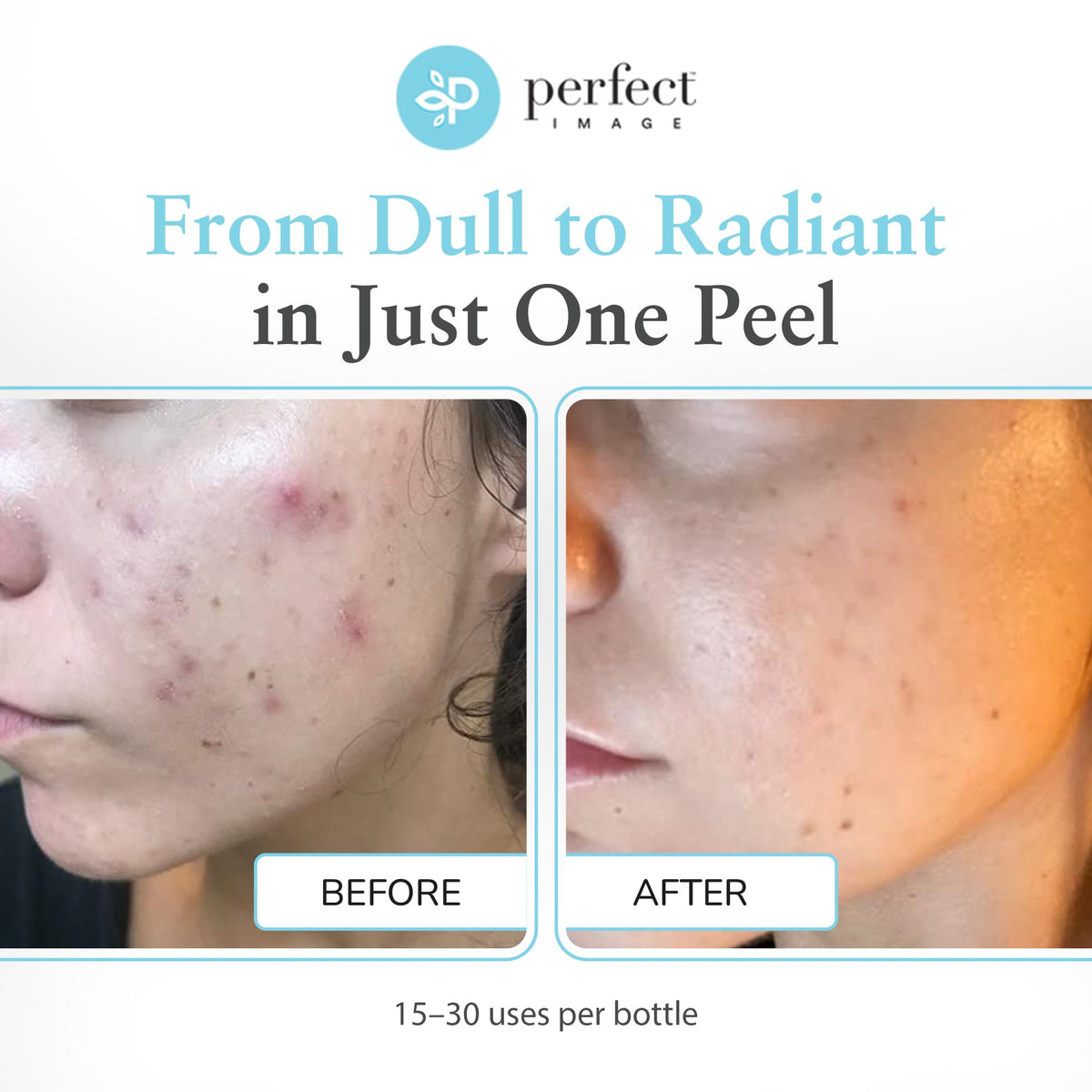 Perfect Image professional application on hand demonstrating controlled treatment
